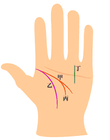 智慧线(甲)与生命线(乙)起点相交，但智慧线中间有分枝(丙)，又出现成功线(丁)